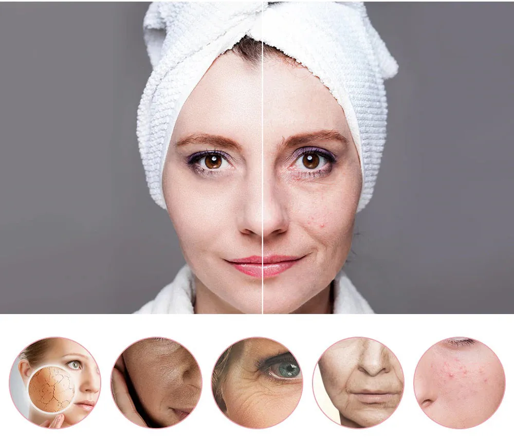 Aparat tratament facial, Mezoterapie 5 in 1
